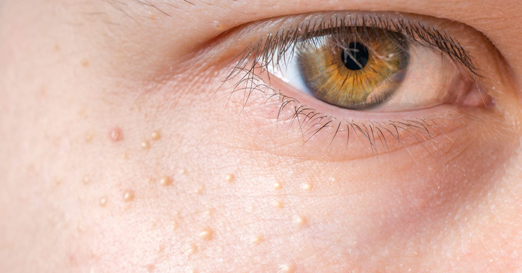 What Are Those White Pimples That Appear Around Your Eyes (Note: Don’t Squeeze Them!) - Featured image