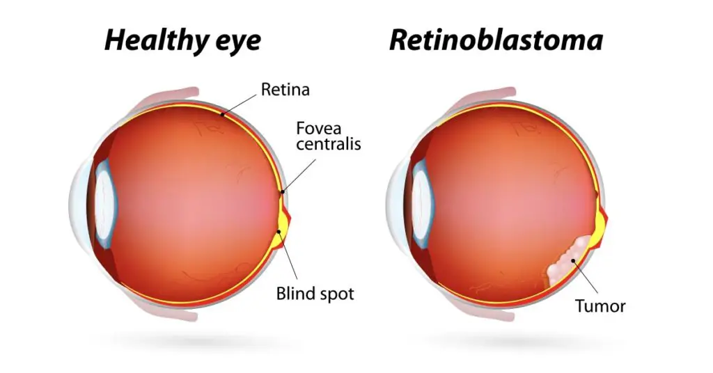 diagram of healthy eye and one with retinoblastoma