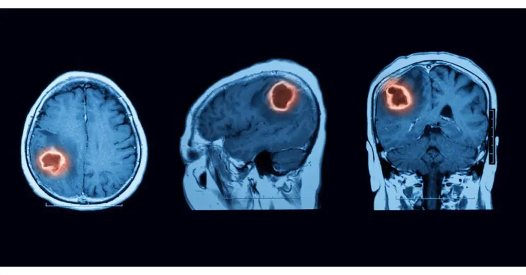 MRI's of brain