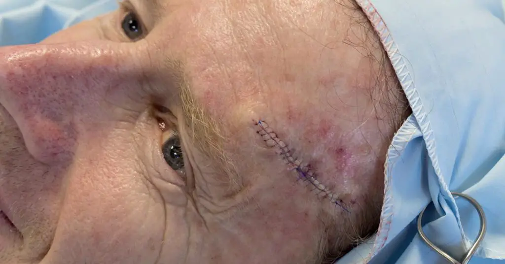 man with stitches on forehead post surgery