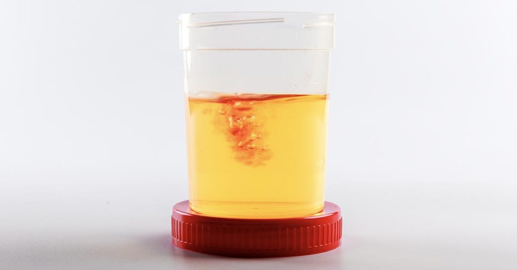 urine sample with small amount of blood