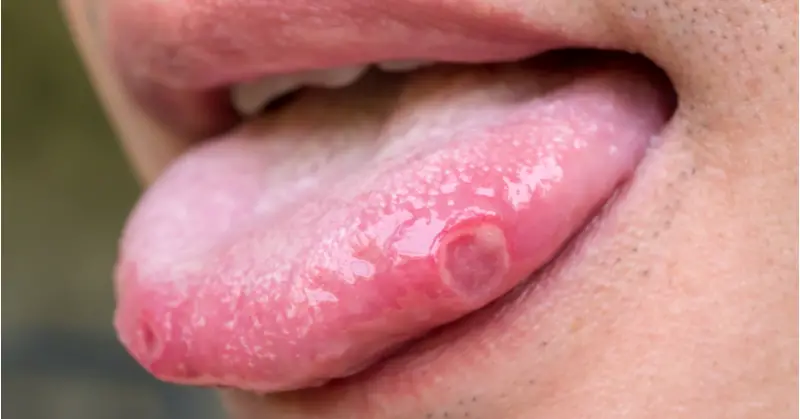 Blisters on tongue
