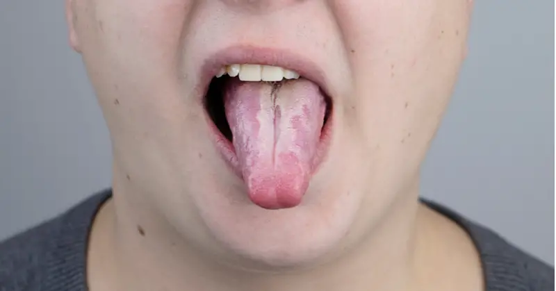 White Plaque on your Tongue