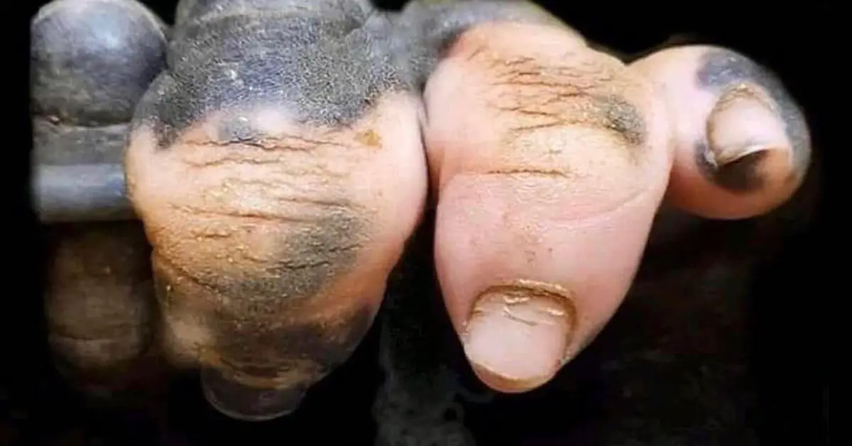 gorilla hand with vitiligo