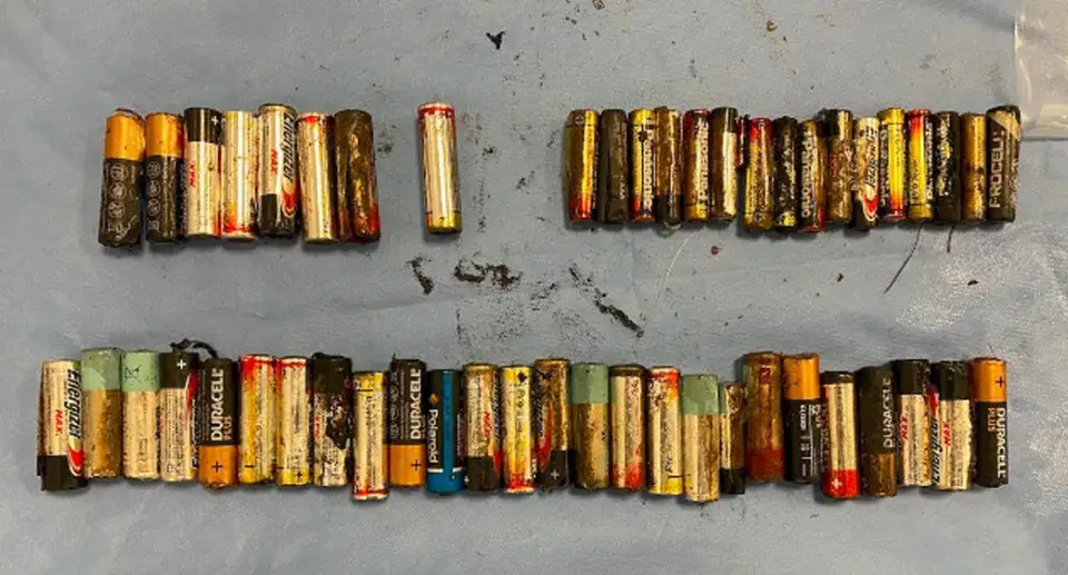 The 55 batteries (AA and AAA) after being successfully extracted from the woman's abdomen.