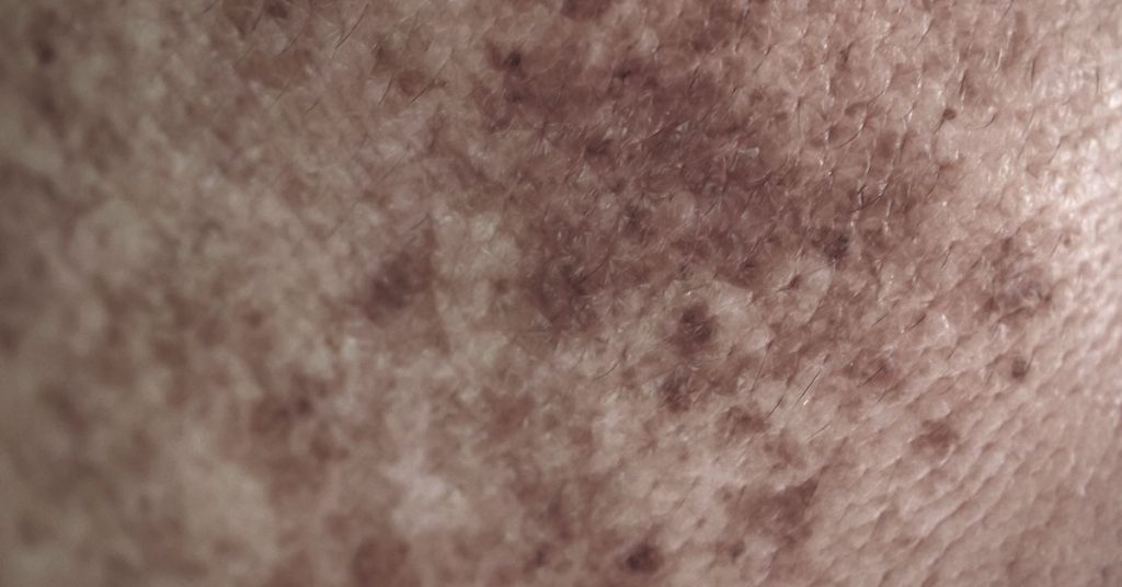 Woman with rare skin condition afraid she’d never find love welcomes baby girl with husband - Featured image