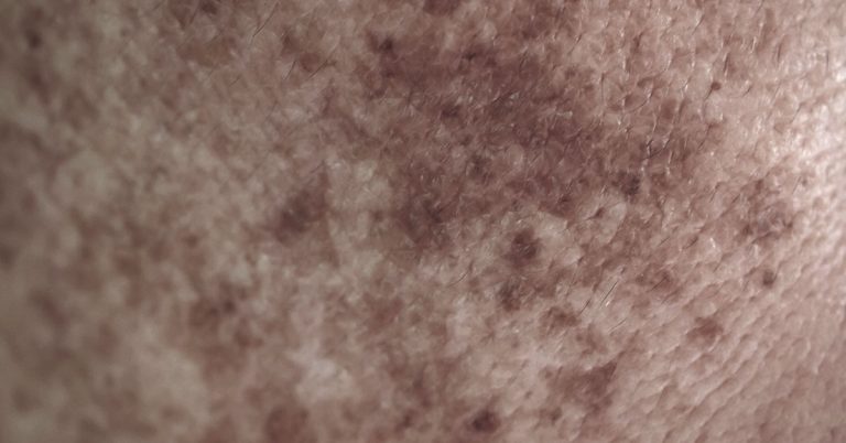 Woman with rare skin condition afraid she’d never find love welcomes baby girl with husband - Featured image