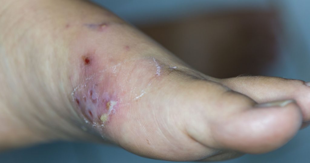 Zooming closeup view of a painful left foot showing acute inflammation on superficial to deep skin and the diagnosis is cellulitis with minimal pus formation in a young Asian female patient
