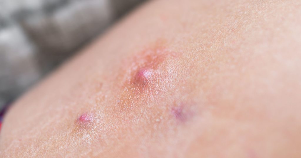 Macro closeup of red swollen boil pimple on leg skin of female woman showing medical condition called hidradenitis suppurativa
