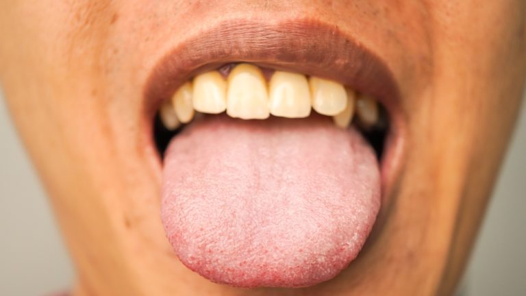 The Importance of Tongue Cleaning: It’s Not Just for Fresh Breath! - Featured image